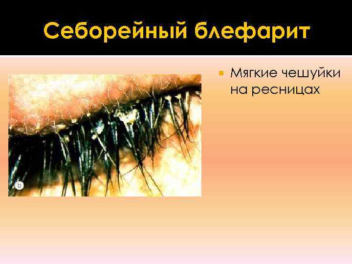 Себорейный блефарит   Мягкие чешуйки   на ресницах 
