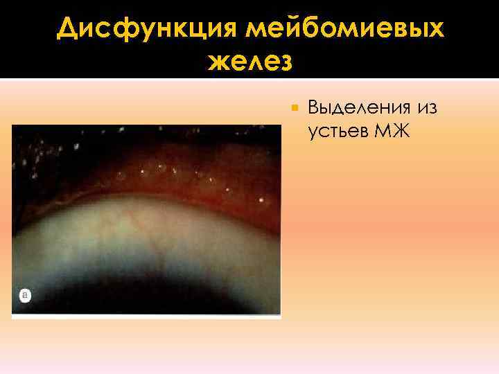 Дисфункция мейбомиевых   желез   Выделения из   устьев МЖ 