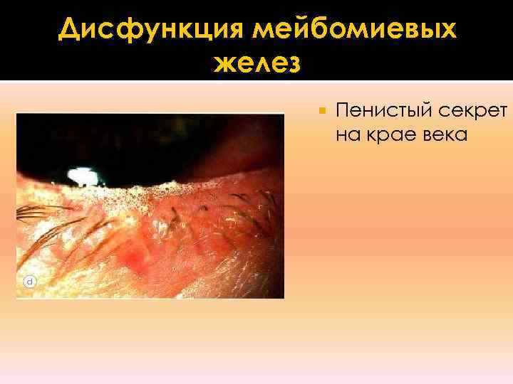 Дисфункция мейбомиевых   желез    Пенистый секрет    на