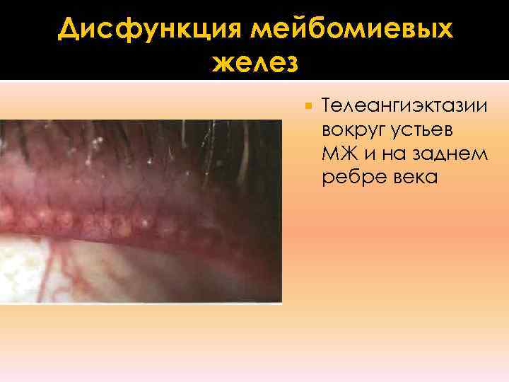Дисфункция мейбомиевых   желез   Телеангиэктазии   вокруг устьев  