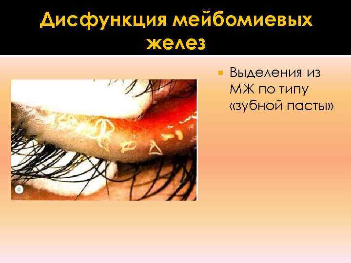 Дисфункция мейбомиевых   желез    Выделения из    МЖ