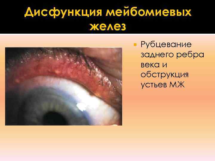 Дисфункция мейбомиевых   желез    Рубцевание    заднего ребра