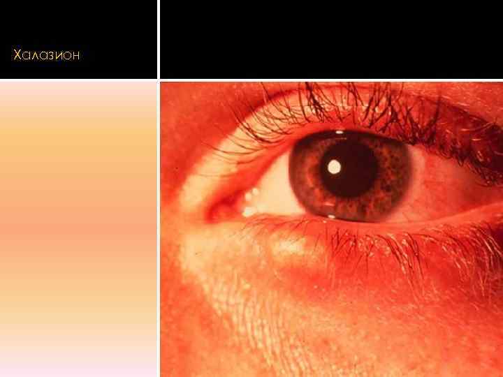 Халазион 