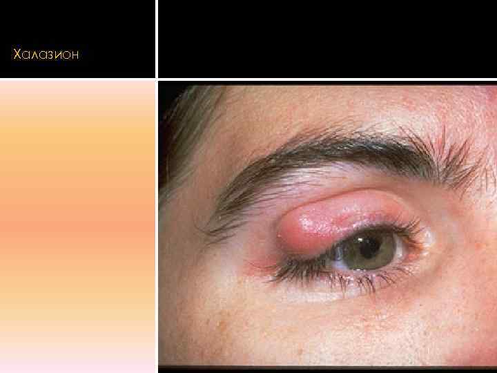 Халазион 