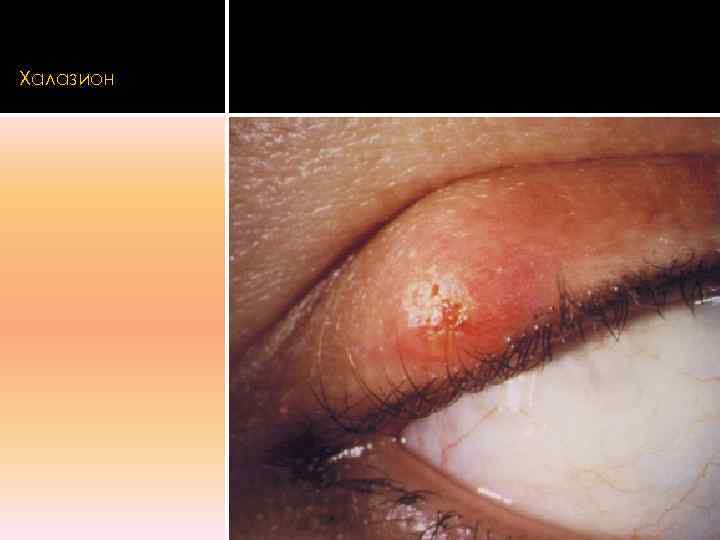 Халазион 