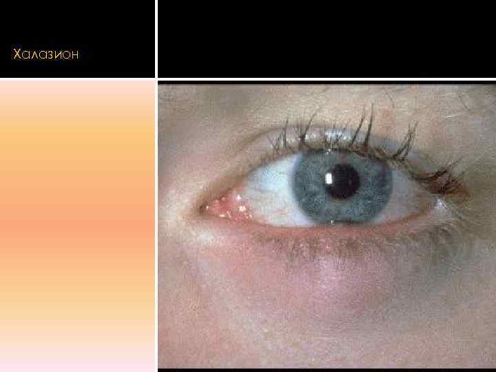 Халазион 