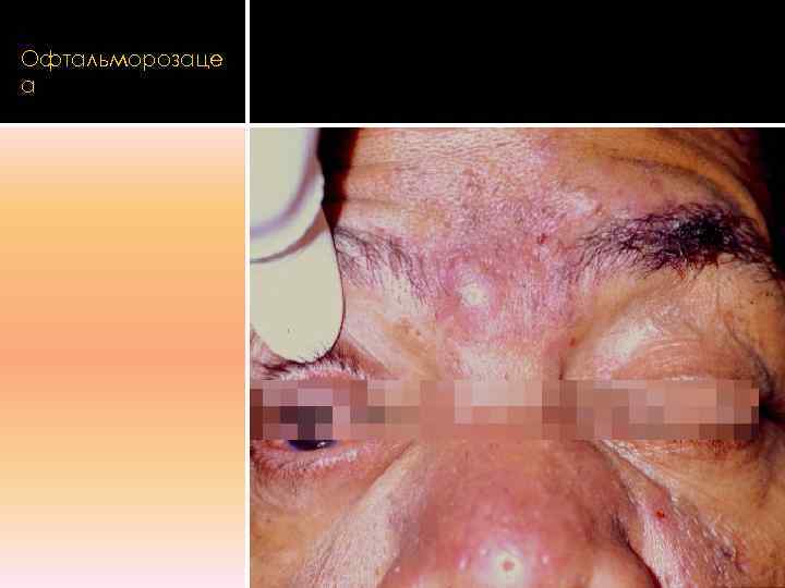 Офтальморозаце а 