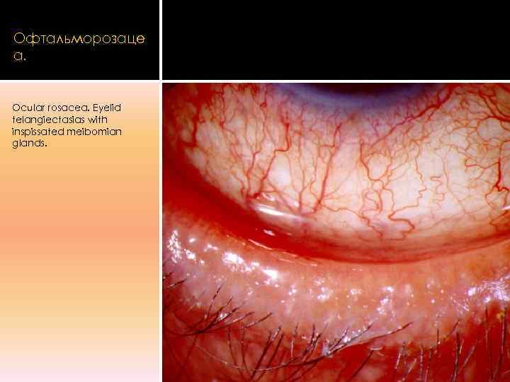 Офтальморозаце а.  Ocular rosacea. Eyelid telangiectasias with inspissated meibomian glands. 