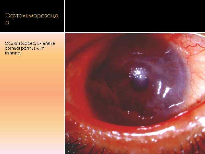 Офтальморозаце а.  Ocular rosacea. Extensive corneal pannus with thinning. 
