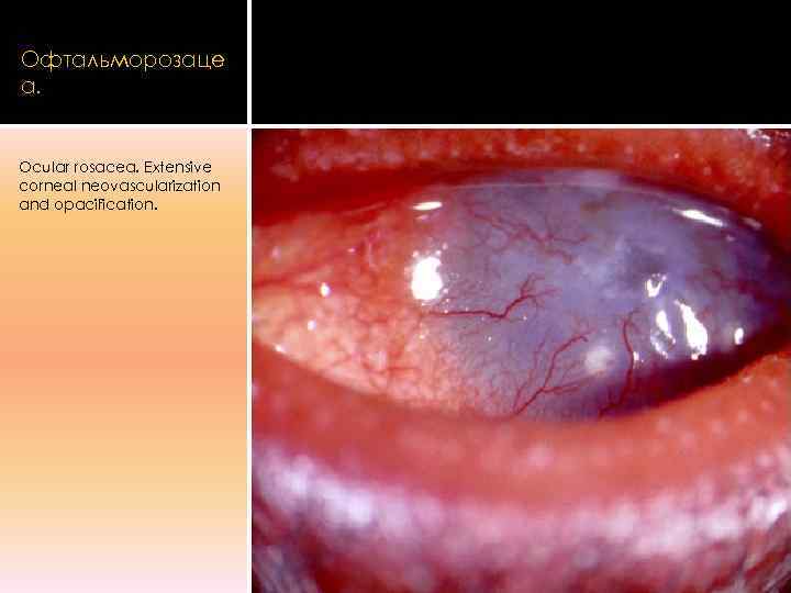 Офтальморозаце а.  Ocular rosacea. Extensive corneal neovascularization and opacification. 