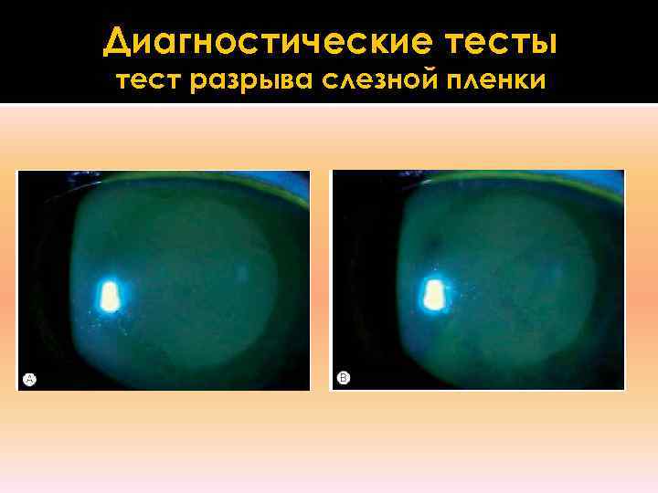 Диагностические тесты тест разрыва слезной пленки 