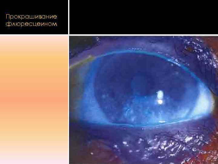 Прокрашивание флюресцеином 