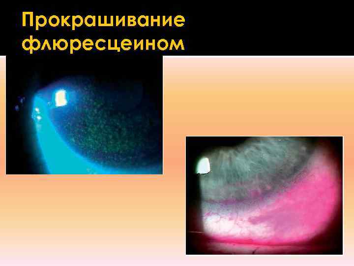 Прокрашивание флюресцеином 