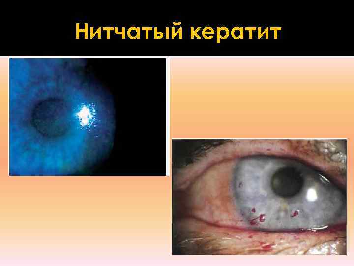 Нитчатый кератит 