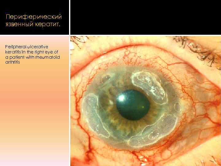 Периферический язвенный кератит.  Peripheral ulcerative keratitis in the right eye of a patient