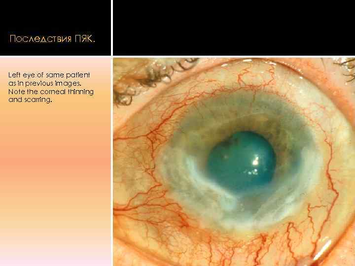 Последствия ПЯК.  Left eye of same patient as in previous images. Note the