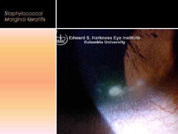 Staphylococcal Marginal Keratitis 