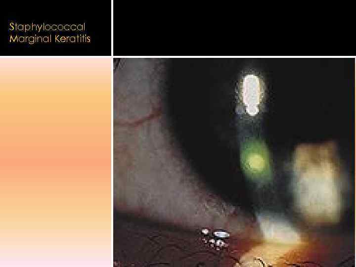 Staphylococcal Marginal Keratitis 