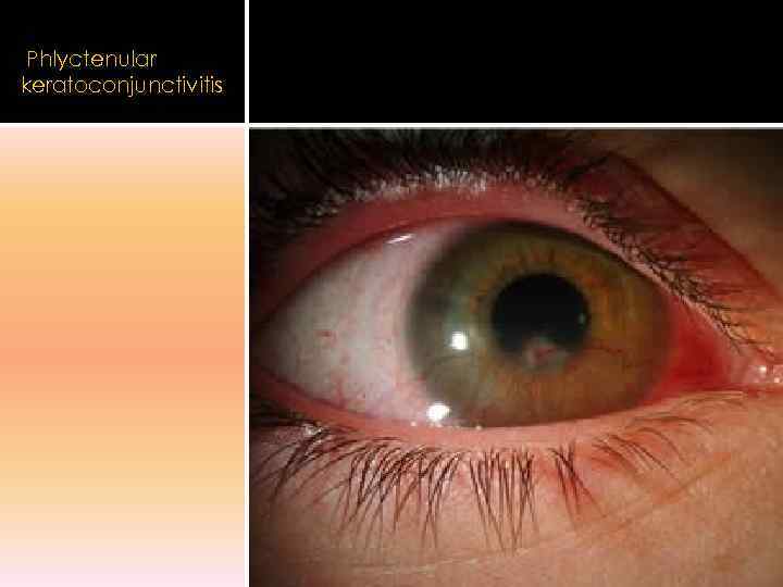  Phlyctenular keratoconjunctivitis 