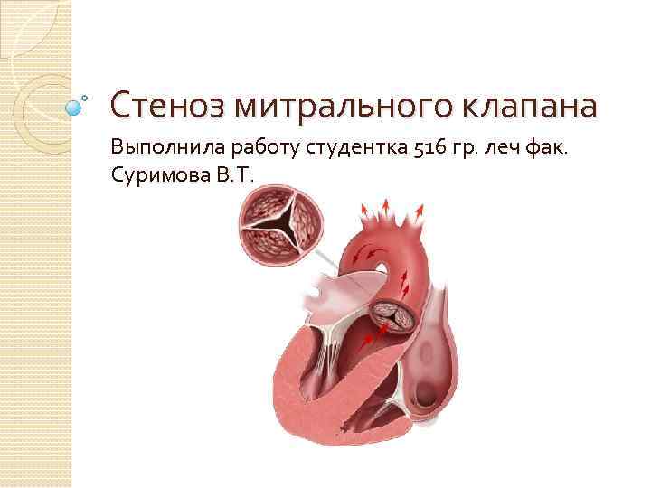 Стеноз митрального клапана Выполнила работу студентка 516 гр. леч фак. Суримова В. Т. 