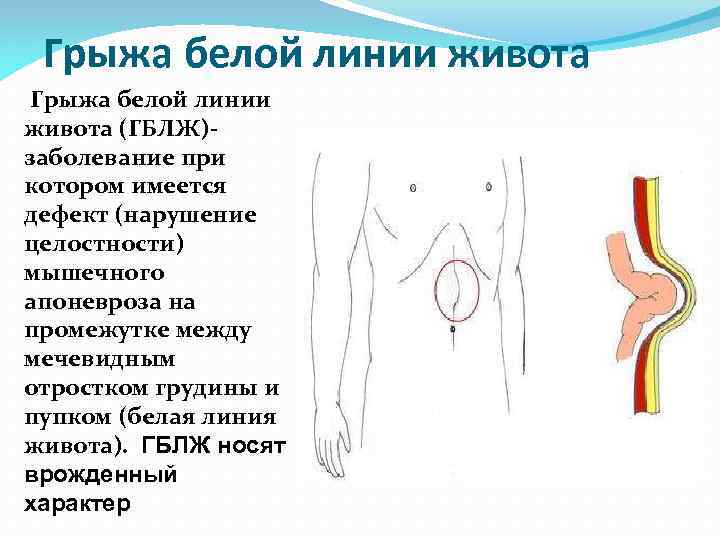 > Грыжа белой линии живота (ГБЛЖ)- заболевание при котором имеется дефект (нарушение целостности) мышечного