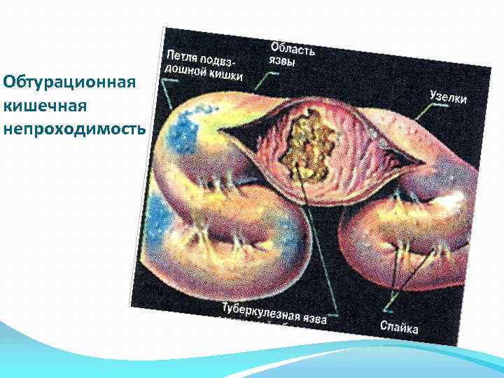 Клиническая картина острой обтурационной толстокишечной непроходимости характеризуется