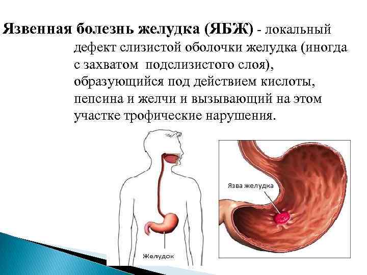 Язвенная болезнь желудка (ЯБЖ) - локальный   дефект слизистой оболочки желудка (иногда 