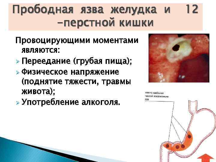 Прободная язва желудка и 12  -перстной кишки Провоцирующими моментами  являются: Ø Переедание