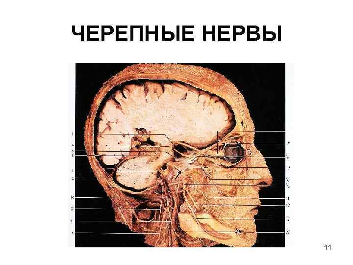 ЧЕРЕПНЫЕ НЕРВЫ     11 
