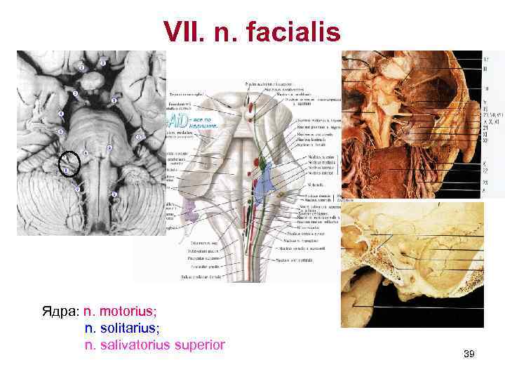     VII. n. facialis Ядра: n. motorius;  n. solitarius; 