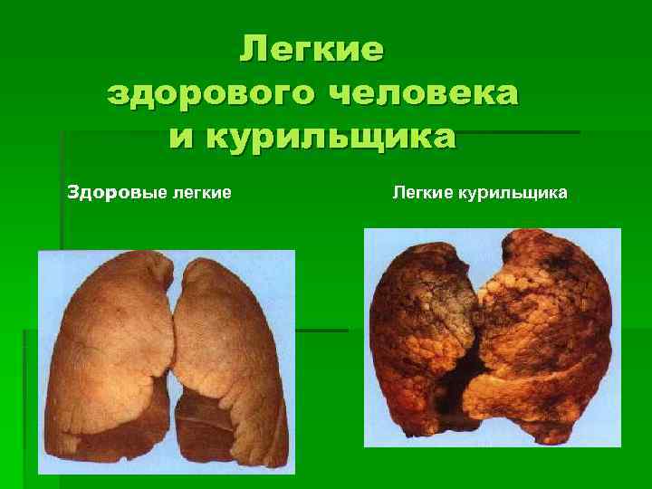    Легкие  здорового человека  и курильщика Здоровые легкие  Легкие
