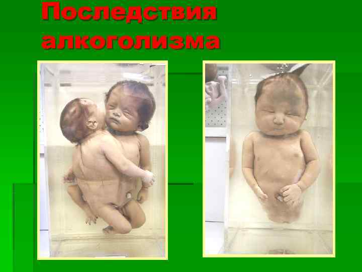 Последствия алкоголизма 