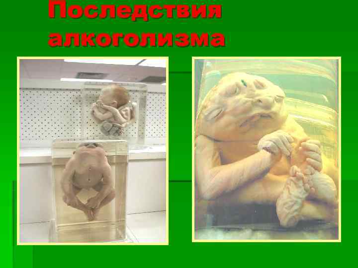 Последствия алкоголизма 