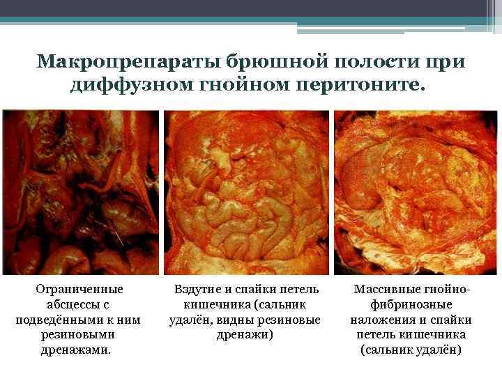 Макропрепараты брюшной полости при диффузном гнойном перитоните. Ограниченные абсцессы с подведёнными к ним резиновыми