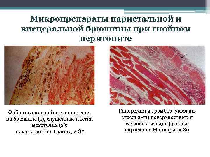 Микропрепараты париетальной и висцеральной брюшины при гнойном перитоните Фибринозно-гнойные наложения на брюшине (I), слущённые