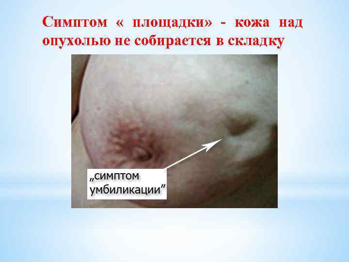 Симптом « площадки» - кожа над опухолью не собирается в складку 