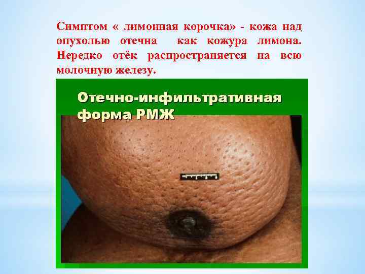 Симптом « лимонная корочка» - кожа над опухолью отечна как кожура лимона. Нередко отёк