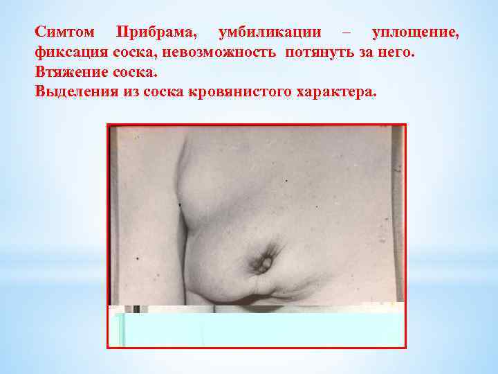 Симтом Прибрама, умбиликации – уплощение, фиксация соска, невозможность потянуть за него. Втяжение соска. Выделения