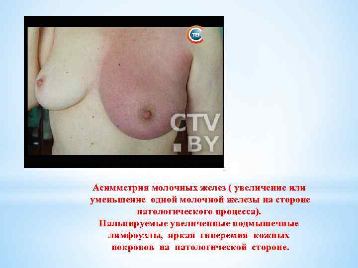 Асимметрия молочных желез ( увеличение или уменьшение одной молочной железы на стороне патологического процесса).