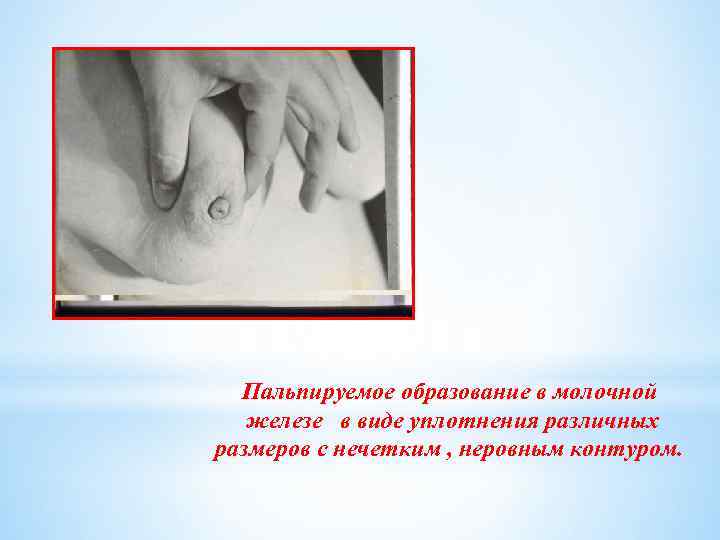 Пальпируемое образование в молочной железе в виде уплотнения различных размеров с нечетким , неровным