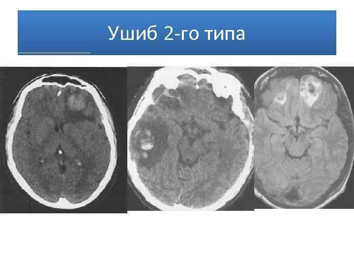 Ушиб головного мозга вред здоровью