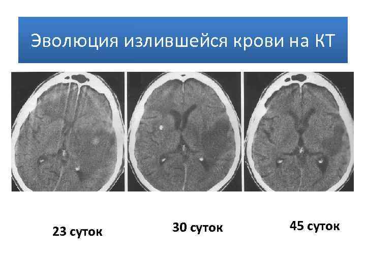 Ушиб головного мозга вред здоровью