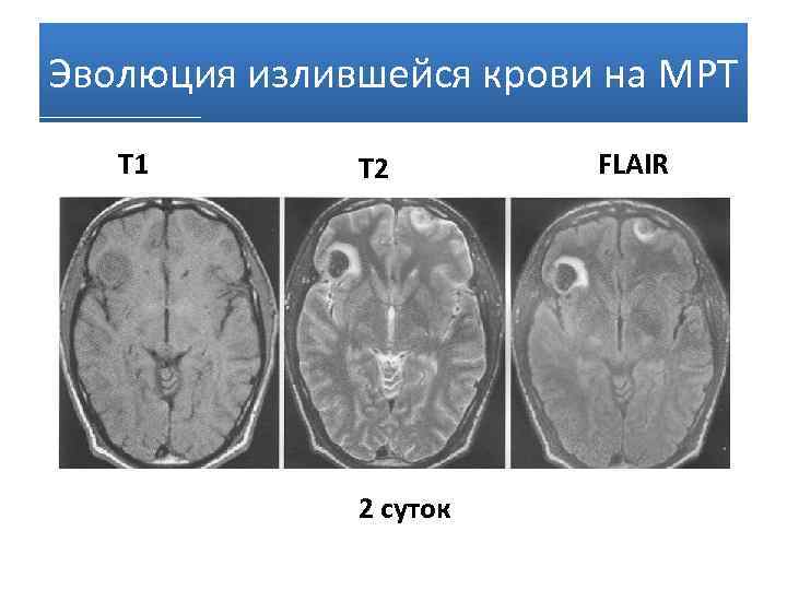 Т1 и т2 взвешенные изображения в мрт