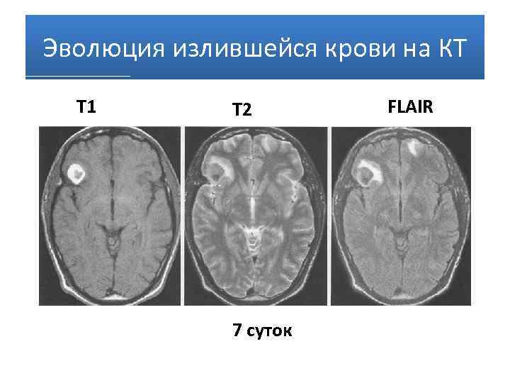 Ушиб головного мозга вред здоровью. Эволюция ушиба головного мозга. Индекс повреждения головного мозга.