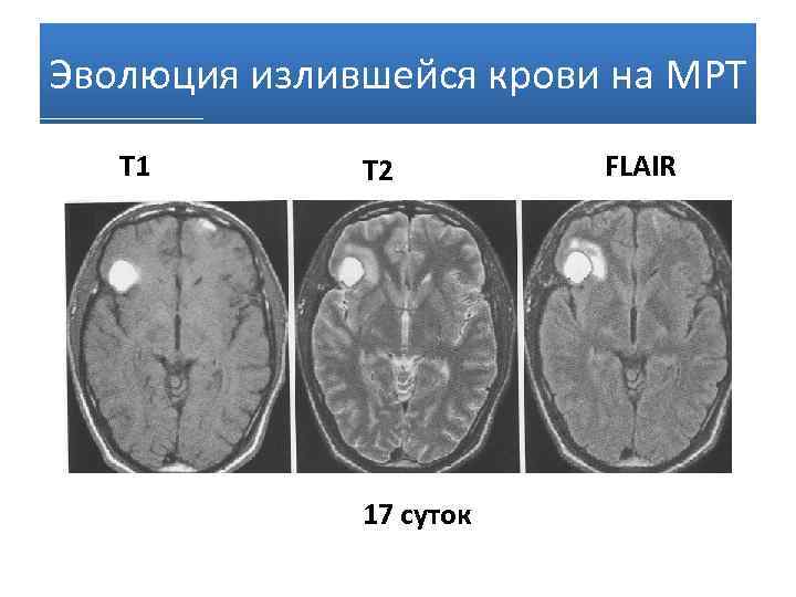 Т1 взвешенное изображение мрт