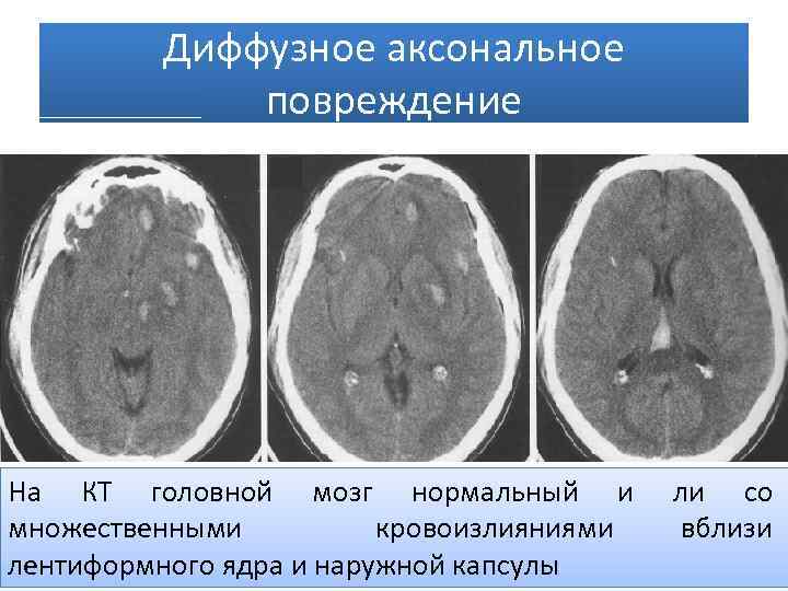 Диффузное поражение мозга. Диффузное аксональное повреждение кт. Аксональное повреждение головного мозга на кт. Диффузное аксональное поражение головного мозга. Диффузно аксональные повреждения головного мозга кт.
