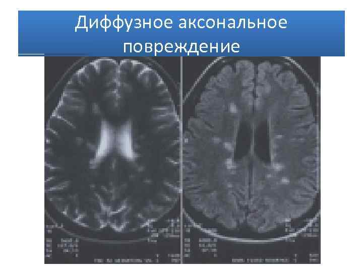 Аксональное поражение моторных волокон