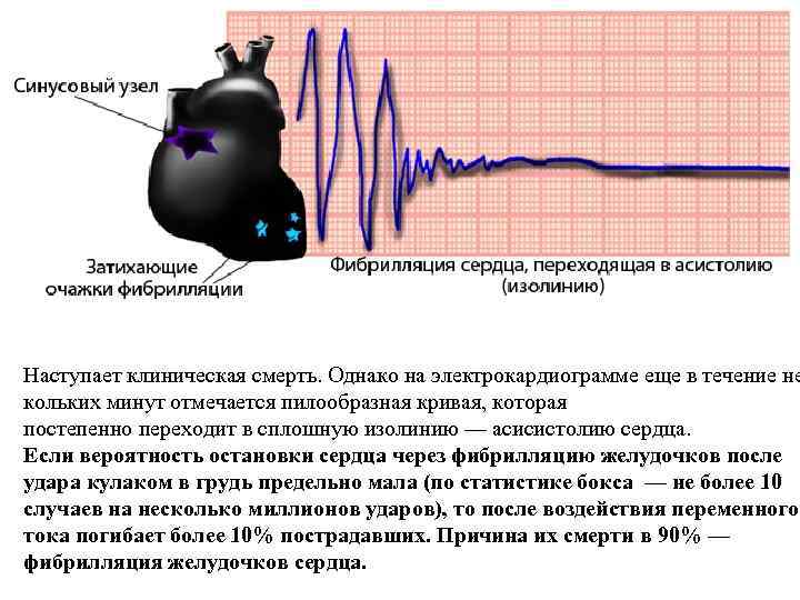 Наступает клиническая смерть. Однако на электрокардиограмме еще в течение не кольких минут отмечается пилообразная