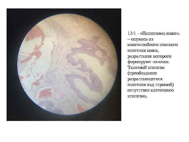13/1 - «Папиллома кожи» . – опухоль из многослойного плоского эпителия кожи, разрастания которого