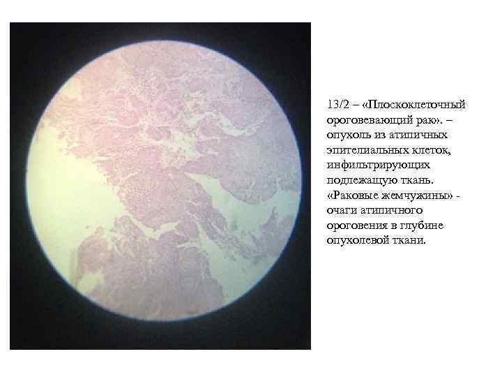 13/2 – «Плоскоклеточный ороговевающий рак» . – опухоль из атипичных эпителиальных клеток, инфильтрирующих подлежащую
